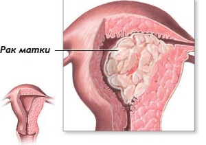 Tratamentul și dieta pentru cancerul uterin după intervenție chirurgicală