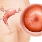 Tratamentul și dieta pentru cancerul uterin după intervenție chirurgicală