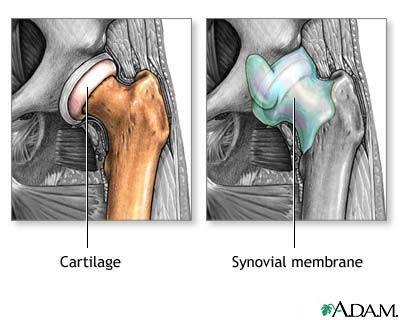 Tratamentul coxartrozei - artroza articulației șoldului
