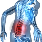 Tratamentul osteocondrozei cu urzica - osteocondroza - cauze, simptome, tratament, diagnostic