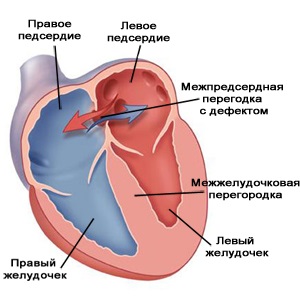 Defecțiune musculară a septului interventricular la nou-născuți, tratament