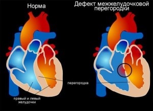 Defecțiune musculară a septului interventricular la nou-născuți, tratament