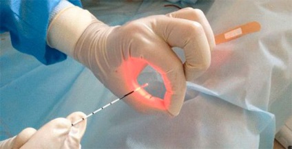 Fie că este posibil să se vindece hemoroizii cu coagulare cu laser laser, ce este