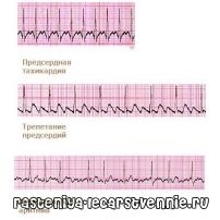 Nadzheludochkovaya tachycardia, kezelés, tünetek, okok - népszerű az egészségről