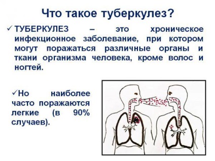 Remediile populare pentru tuberculoza pulmonară la adulți la domiciliu, cum se determină ce trebuie tratat