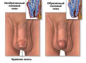 Circumcizia, urologul meu