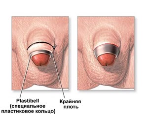Circumcizia, urologul meu