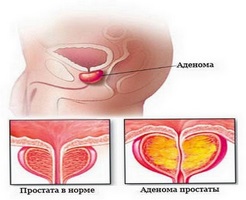 Transpirație pe fondul prostatitei