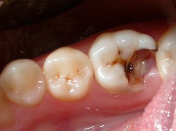 A fogszuvasodás operatív kezelése