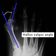 Операції і лікування hallux valgus