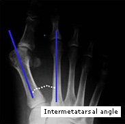 Operațiunea și tratamentul hallux valgus