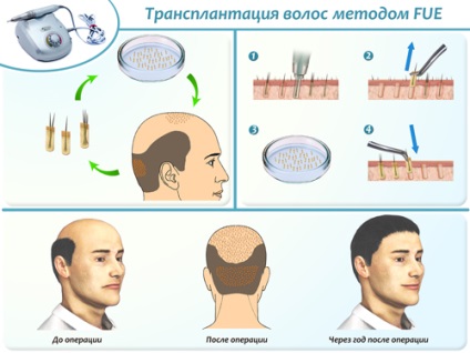 Transplantul de păr