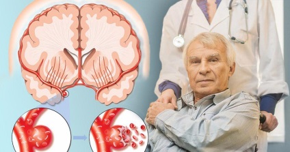 Primele simptome ale unui accident vascular cerebral