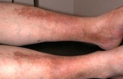 Pete pigmentate pe picioarele cauzei, fotografie, tratament