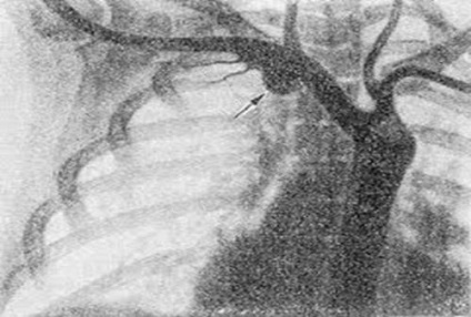 Artera subclaviană (stânga și dreapta), puncția venei subclavice