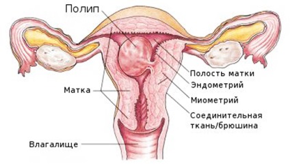 Polip a méhben - következmények és lehetséges szövődmények