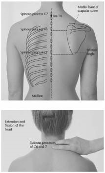 Element dispozitiv, acupunctura, acupunctura