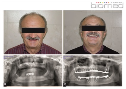 Exemple de implantare a dinților