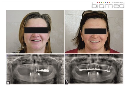 Exemple de implantare a dinților