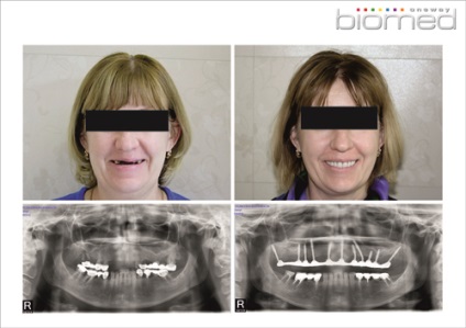 Exemple de implantare a dinților