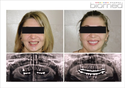 Exemple de implantare a dinților