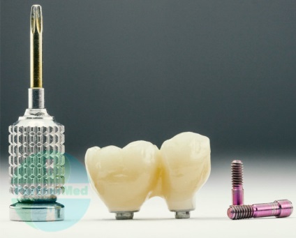 Instalarea protezelor de proteze dentare pe implanturi, prețurile pentru protezele detașabile și nedemontabile pentru