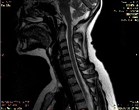 Protruzia discului intervertebral - ceea ce este, cauze, simptome, diagnostic, tratament