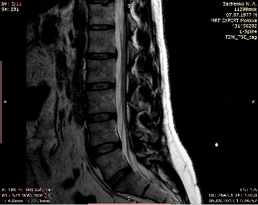 Protruzia discului intervertebral - ceea ce este, cauze, simptome, diagnostic, tratament