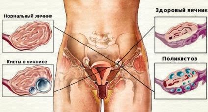 Cauzele psihosomatice ale chisturilor ovariene