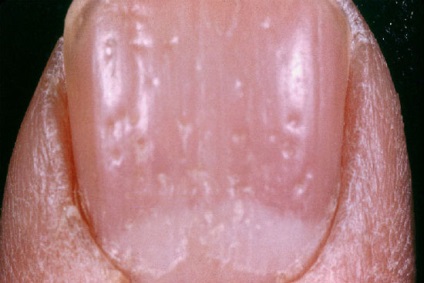 Psoriazisul unghiilor - tratament, simptome și cauze, fotografie
