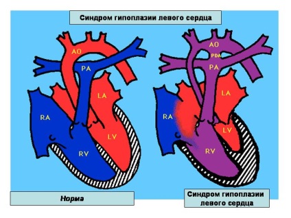 Sindromul de hipoplazie a inimii stângi la făt, la nou-născuți