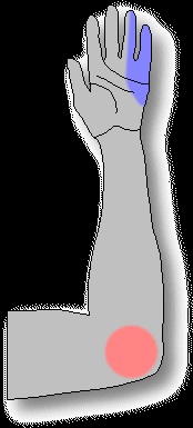 Sindromul canalului cubital (sindromul ulnar), centrul neurochirurgiei cerebrovasculare vasculare