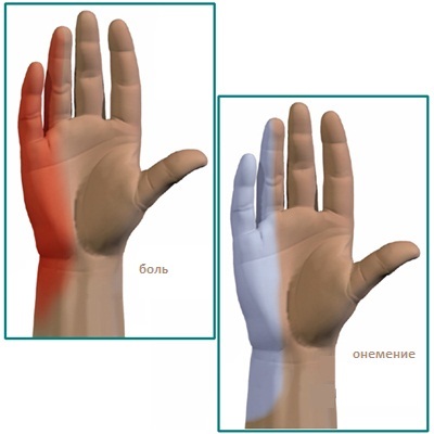 Sindromul canalului cubital (sindromul ulnar), centrul neurochirurgiei cerebrovasculare vasculare