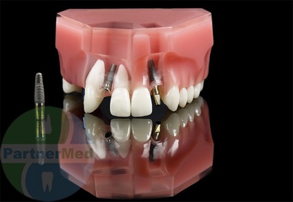 Metode moderne de tipuri și metode de proteză dentară