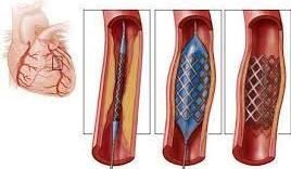 Stentul arterelor coronare din clinica rambram