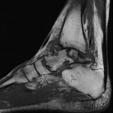 Oasele talusului - anatomia, consecințele fracturii, osteomului și necrozei talusului - viața mea