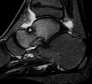 Oasele talusului - anatomia, consecințele fracturii, osteomului și necrozei talusului - viața mea