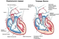 Tetralogia de falus și simptomele sale de tratament, cauze, clasificare