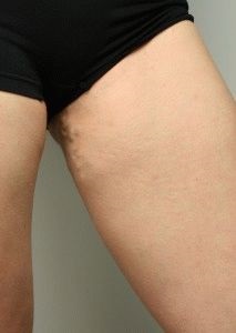 A kismedencei tünetei és kezelése varicose veins