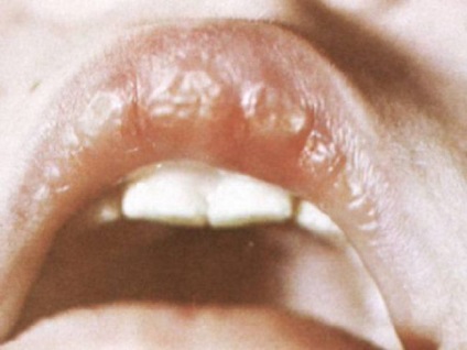 Видове хейлит по устните, както и причините за тяхното развитие, как за лечение на болестта, както и традиционна народна