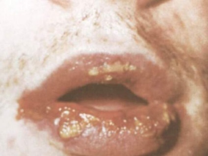 Видове хейлит по устните, както и причините за тяхното развитие, как за лечение на болестта, както и традиционна народна