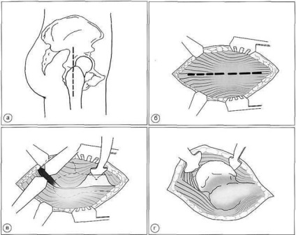 Accesul chirurgical la articulația șoldului cu endoprotetice