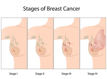 Întârzierea debutului chimioterapiei crește riscul de deces în cancerul de sân - natura contra cancerului