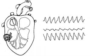 Tahicardie ventriculară - tratamentul patologiei cardiace prin metode populare