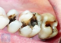 зъбите венците