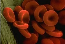мегалобластна анемия