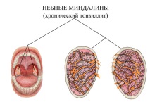 тонзилит