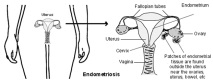 ендометриоза