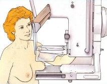 мамографията
