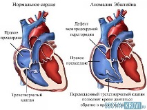 аномалия